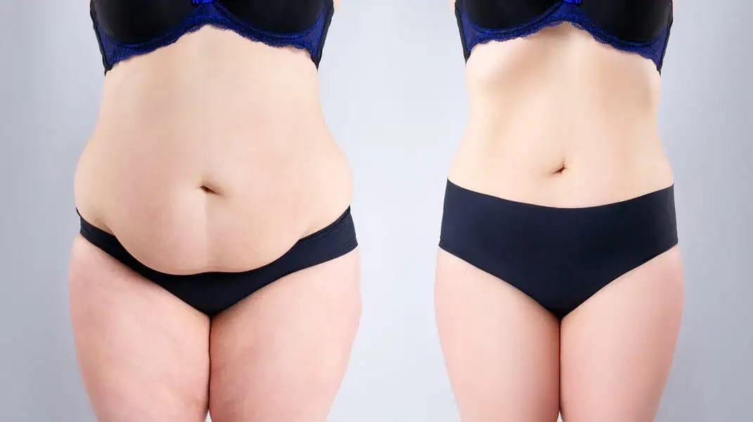 Morpheus8 Face & Body Treatments in McMurray, PA