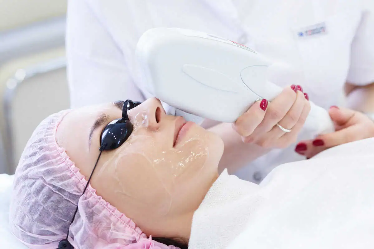 IPL treatment in McMurray, PA for skin rejuvenation and sun damage correction