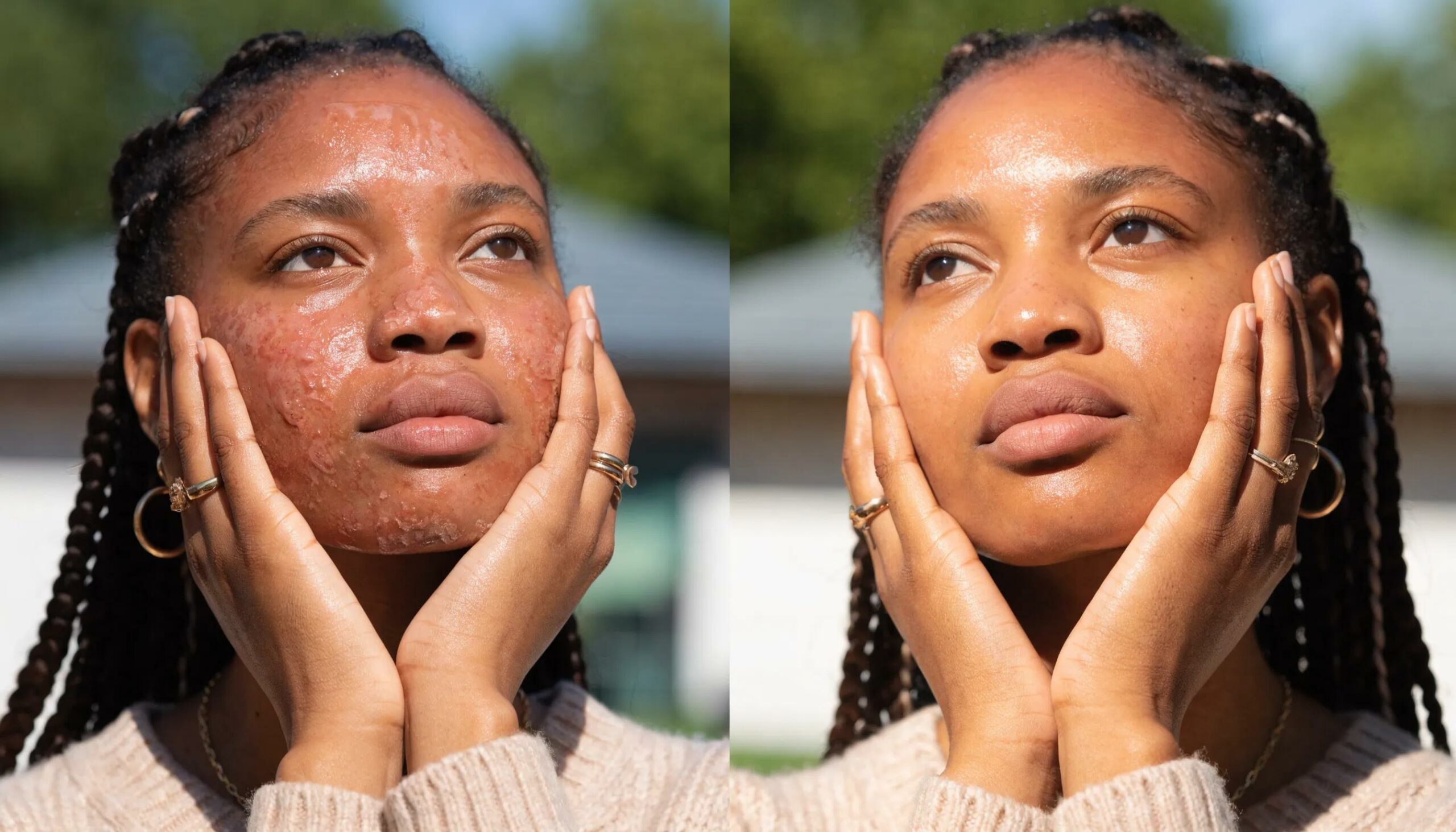 Before and after photo of skin healing following a chemical peel